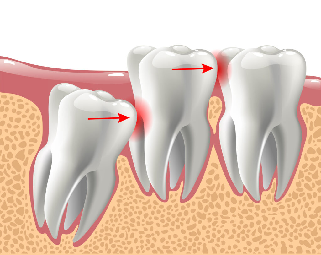 Picture of an impacted wisdom tooth