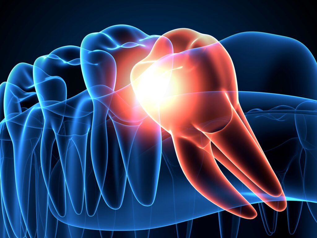 CGI image of a blue transparent jaw and teeth with wisdom tooth growing in orange