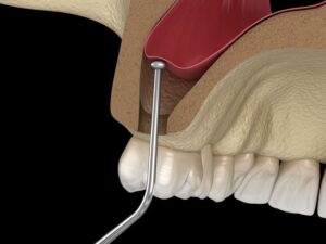 Illustration of instrument being used to lift sinus